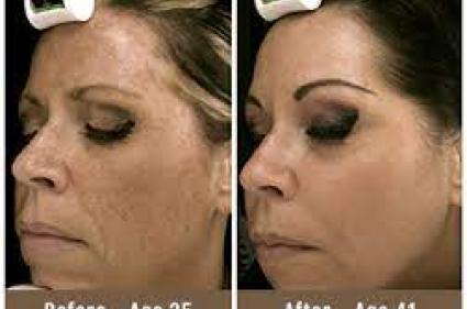 Before and after Microlaser Peel