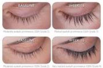 Latisse before and after.