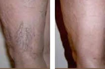 Before and after sclerotherapy