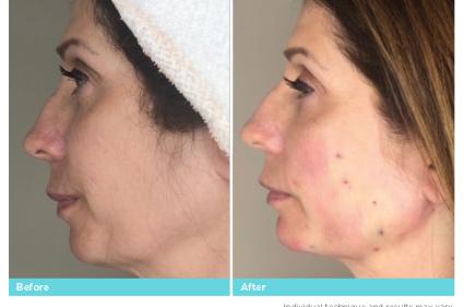 before and after