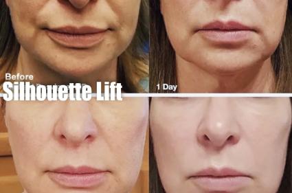 Silhouette lift before and after